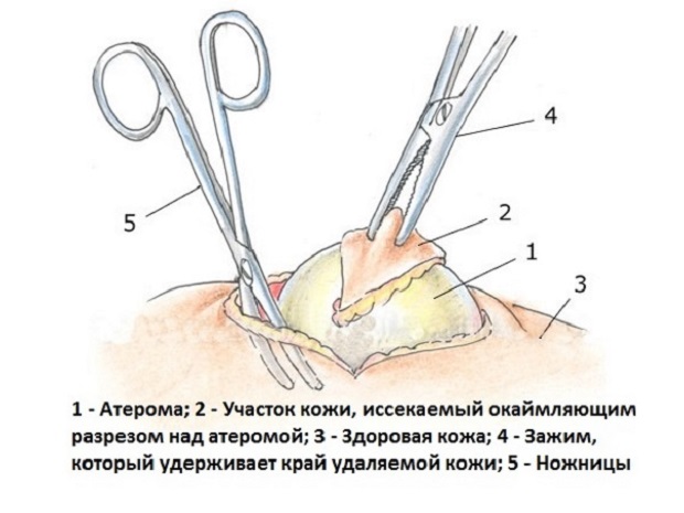 Способы удаления атеромы волосистой части головы: хирургия, лазер и другие