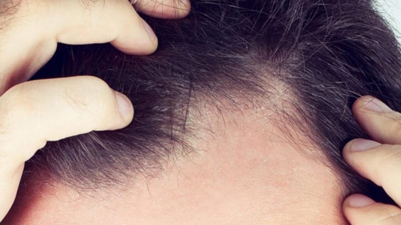 Эффективные методы лечения жирной себореи кожи головы