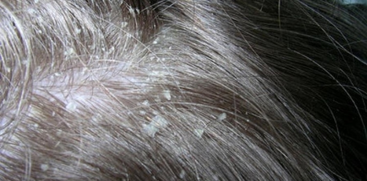 Фото сухой себореи кожи головы