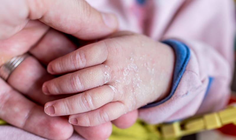 Что делать, если у новорожденного шелушится кожа на теле