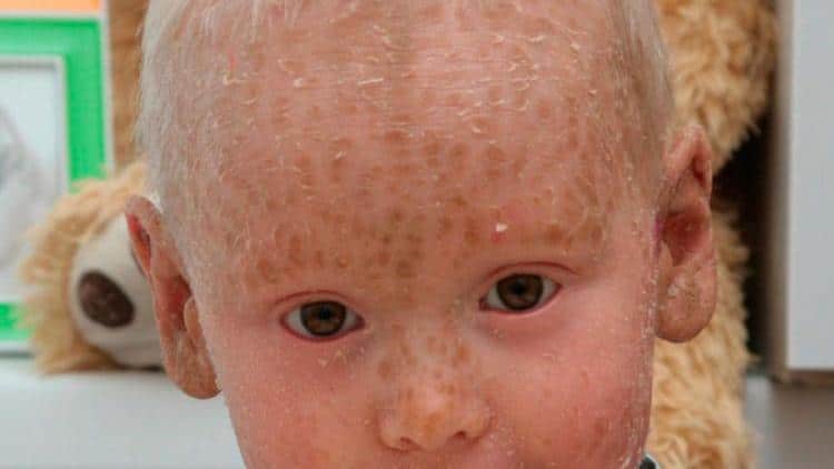 Что такое ихтиоз кожи, и можно ли вылечить это заболевание