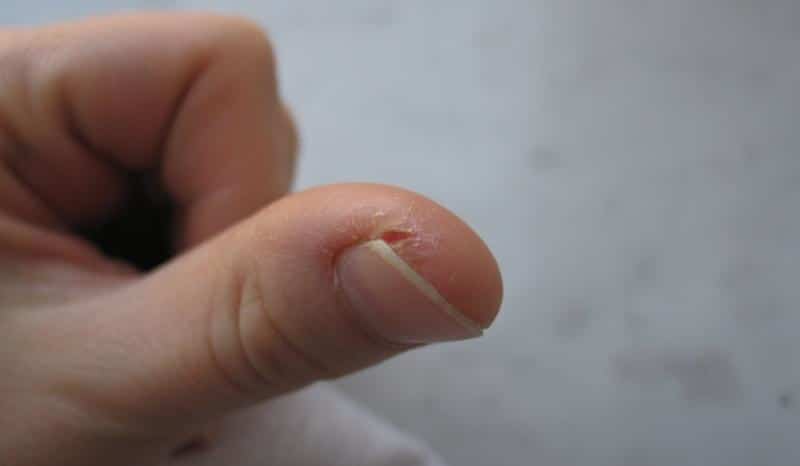 Что делать, если трескается кожа на пальцах рук около ногтей