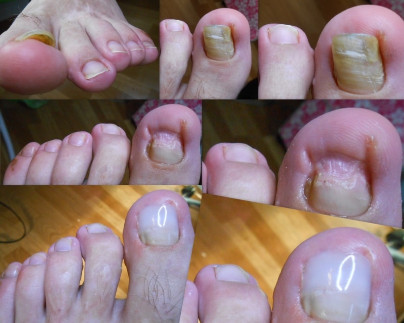 Онихолизис или отслоение ногтя от ногтевого ложа: как лечить в домашних условиях