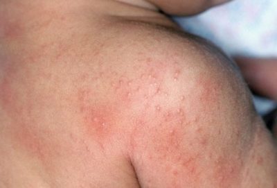 что делать если вышел прыщ на подмышке. Смотреть фото что делать если вышел прыщ на подмышке. Смотреть картинку что делать если вышел прыщ на подмышке. Картинка про что делать если вышел прыщ на подмышке. Фото что делать если вышел прыщ на подмышке